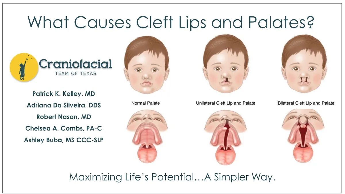 Understanding and Treating Cleft Lip and Palate: A Comprehensive Guide