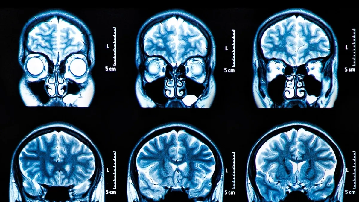 The Future of ADHD Diagnosis: A Deeper Look into Brain Scans
