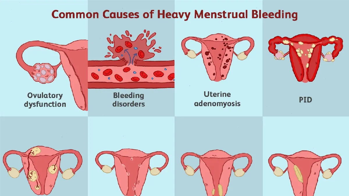 Managing Heavy Menstrual Bleeding: The Role of Vitamin K and More