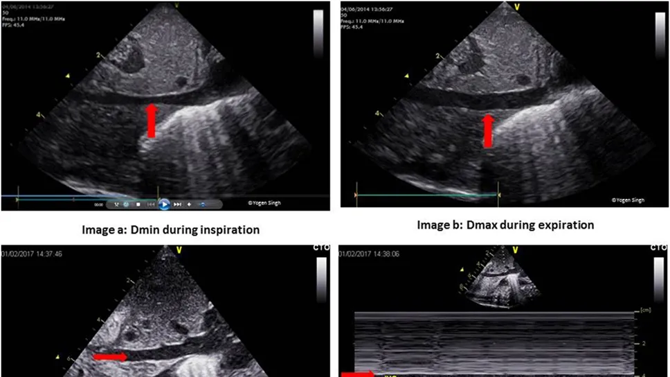 Echocardiography in Neonatal Sepsis: An Essential Tool for Hemodynamic Assessment