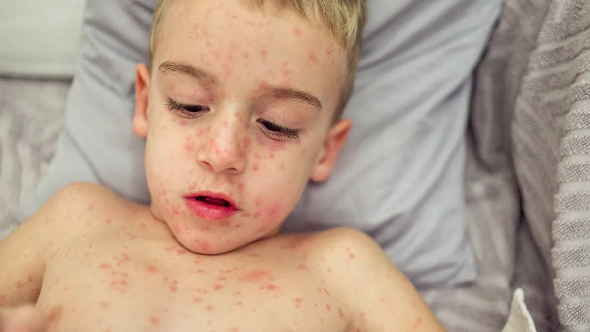 Understanding and Combating the Recent Measles Outbreak