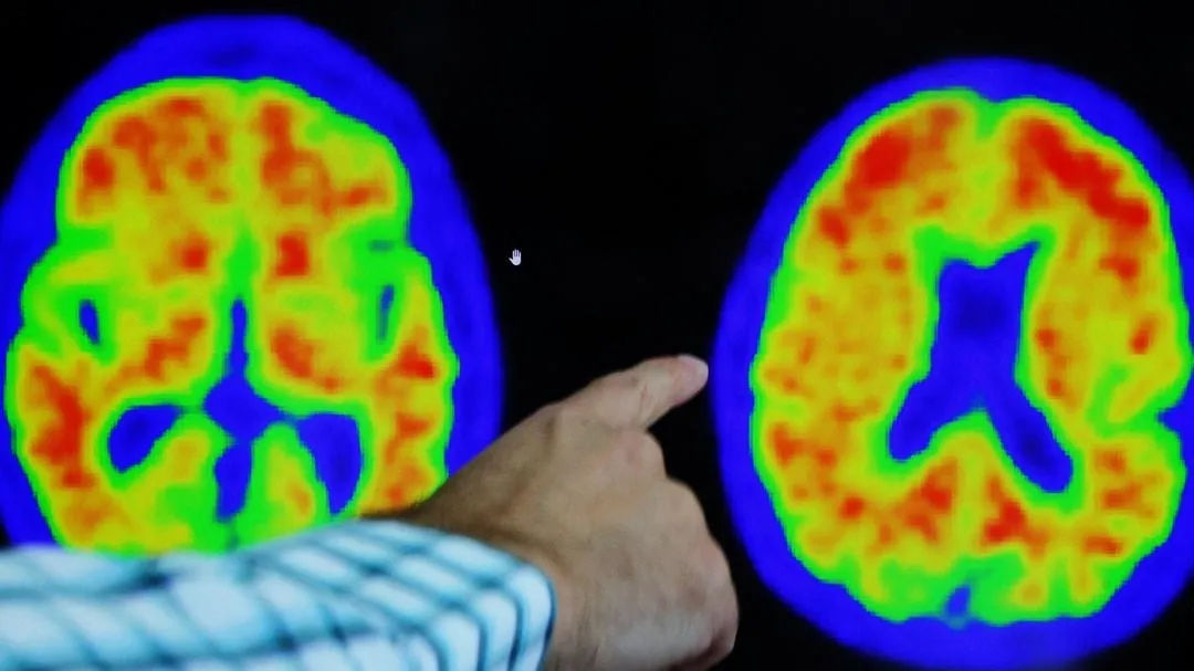 Medicare Covers Amyloid-PET Scans for Early Alzheimer’s Detection: A Boon or a Bother?