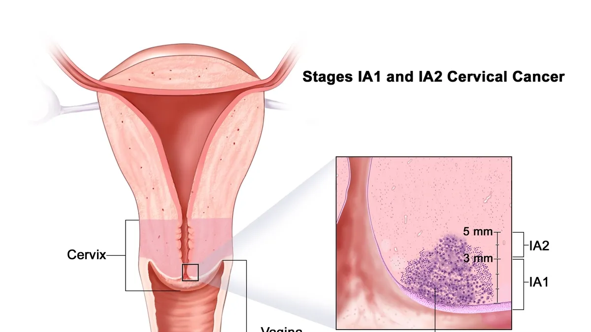 TARGIT-FX: A New Hope for Advanced Cervical Cancer Treatment