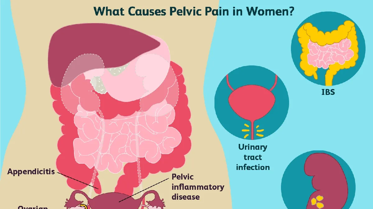 Understanding and Managing Pelvic Pain in Women: Causes, Diagnosis, and Treatment