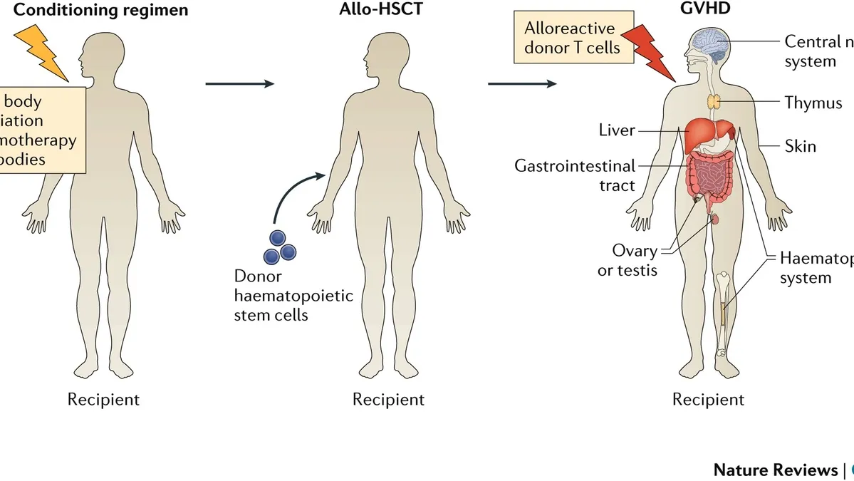 Allogeneic Hematopoietic Cell Transplantation: A Potential Cure for Non-Malignant Hematological Diseases