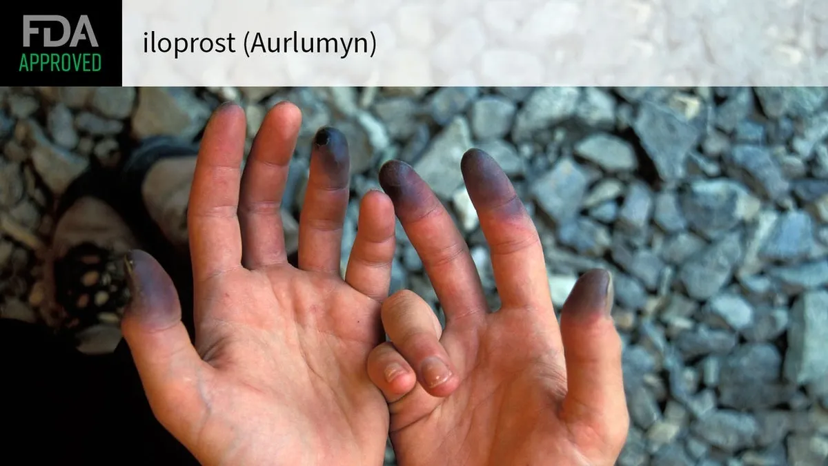 FDA Approves Aurlumyn (Iloprost) – A Groundbreaking Treatment for Severe Frostbite