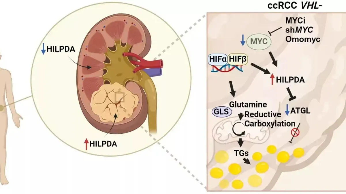 Unveiling New Therapeutic Targets for Kidney Cancer: The Role of MYC and HILPDA Proteins