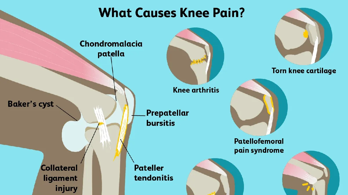 Unraveling the Complexities of Knee Pain: Causes, Diagnosis, and Management
