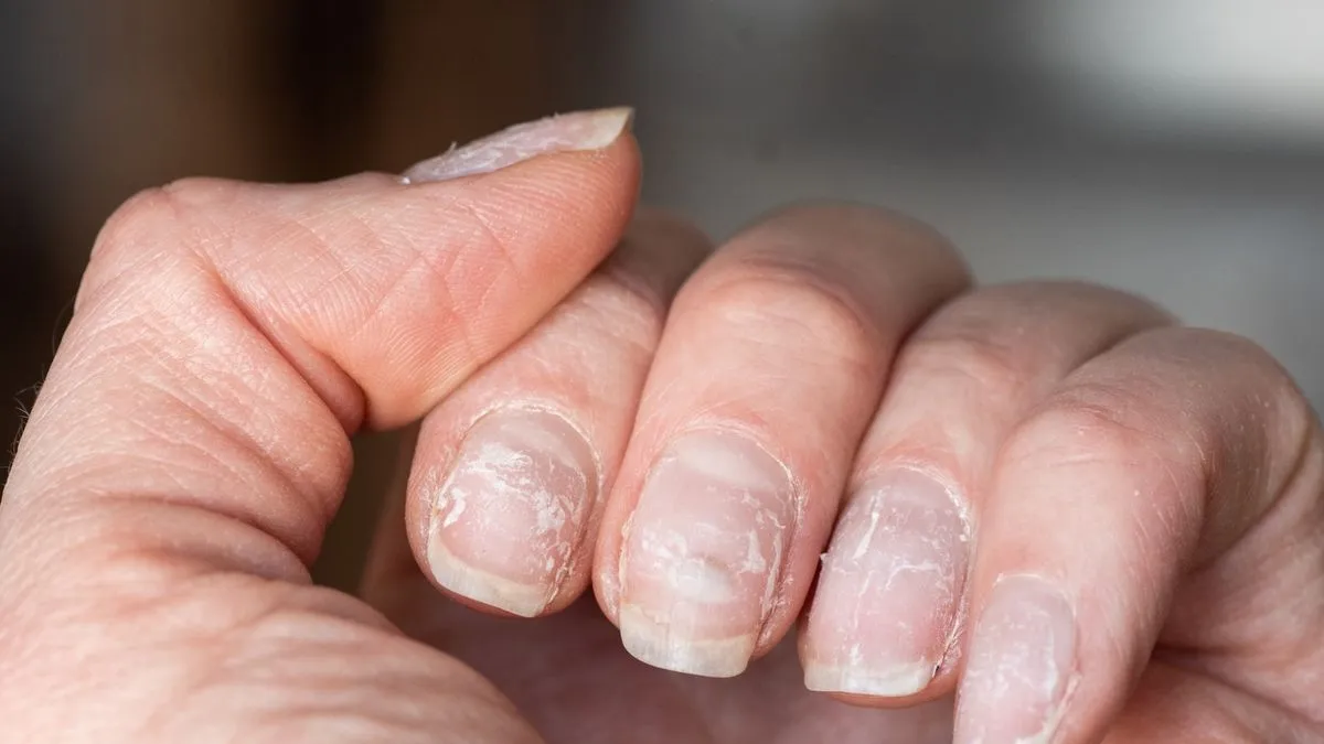 Unraveling the Mystery of Peeling Nails: Causes, Remedies, and Prevention