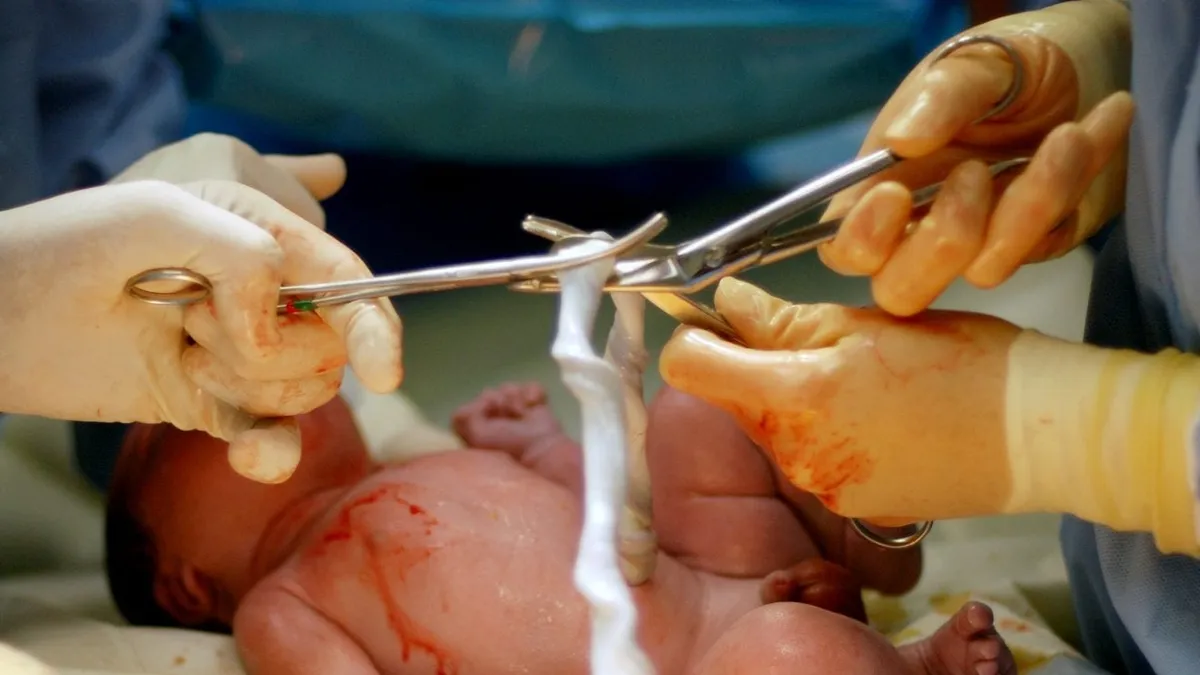 New Study Suggests Delayed Cord Clamping Can Improve Survival Rates in Preemies
