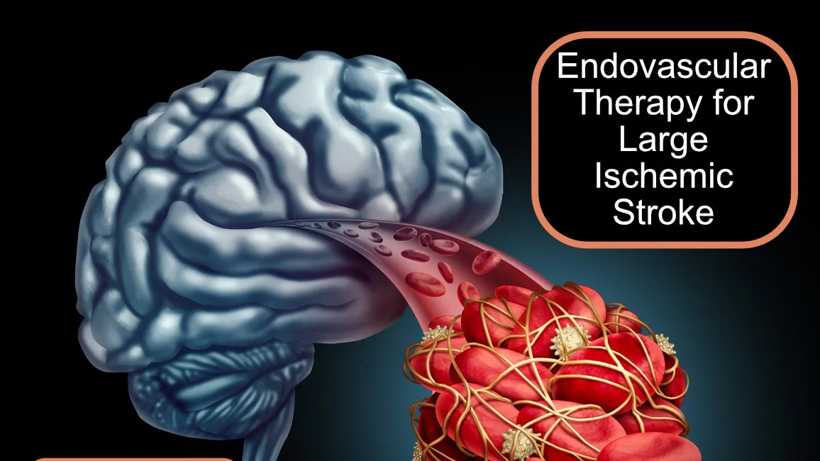 Endovascular Thrombectomy: A Game Changer in the Treatment of Large Ischemic Stroke