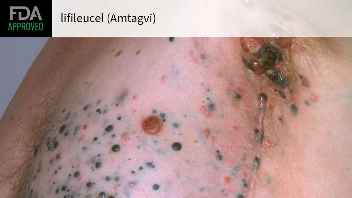 Amtagvi: A Groundbreaking Cellular Therapy for Advanced Melanoma