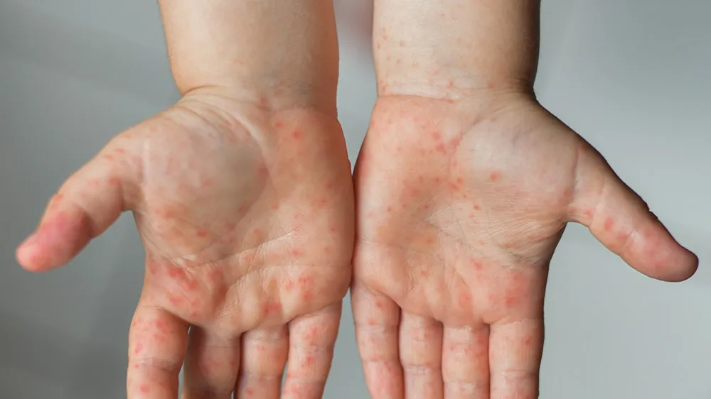 Understanding Hand, Foot, and Mouth Disease: Symptoms, Treatment, and Prevention