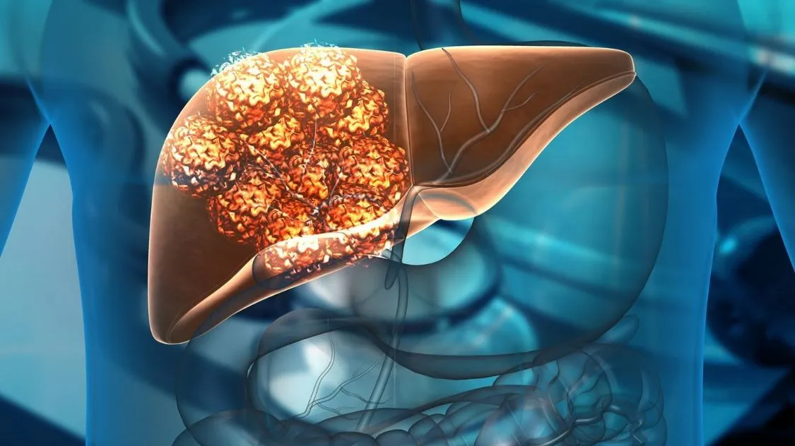 A Revolutionary Approach to Liver Tumor Treatment: Magnet-Guided Microrobots
