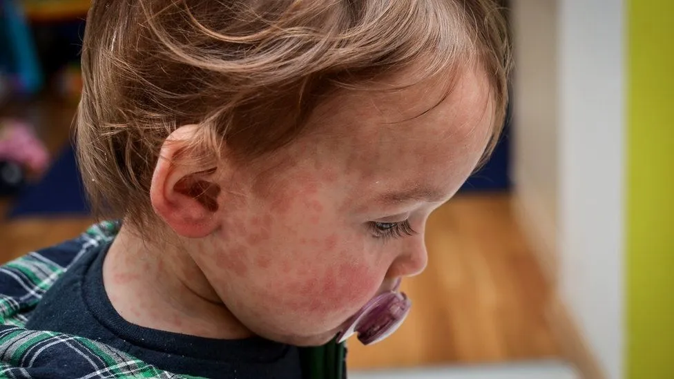 First Measles Case in Seven Years Confirmed in Northern Ireland: The Urgency of Vaccination
