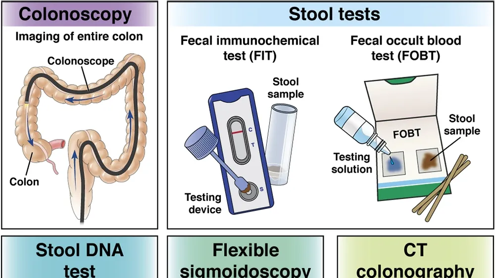 New Stool Test to Revolutionize Colorectal Cancer Screening