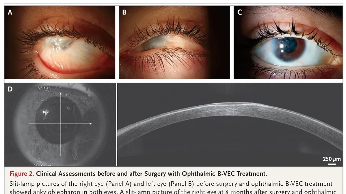 A Ray of Hope for Dystrophic Epidermolysis Bullosa Patients: The Promising Results of Ocular Gene Therapy