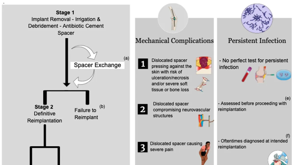 A Comparative Insight into One-Stage and Two-Stage Treatment for Periprosthetic Joint Infection (PJI)