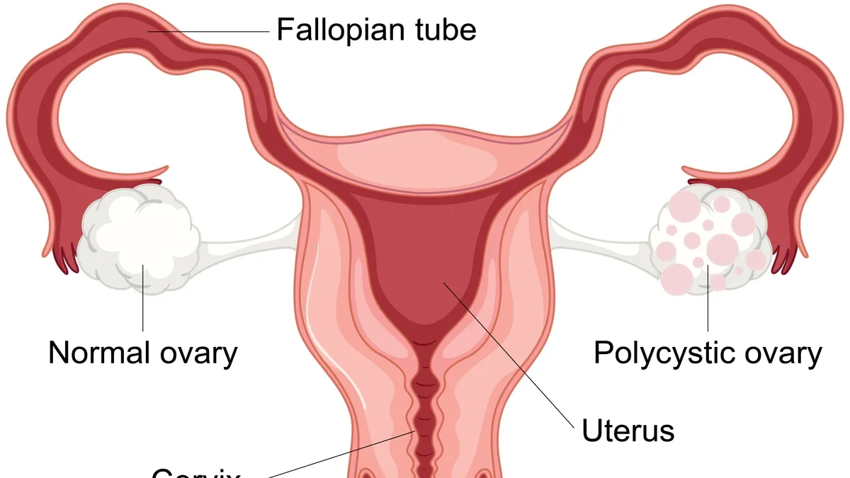 Understanding Polycystic Ovary Syndrome (PCOS): Risks, Symptoms and Management
