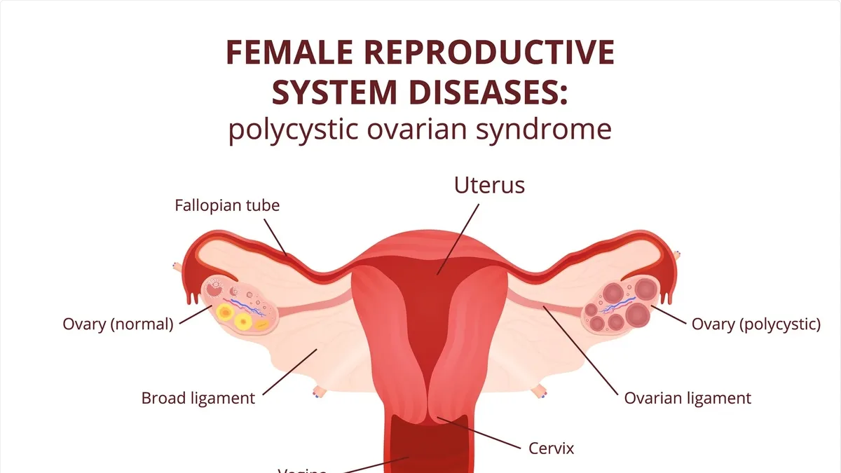 Unraveling the Complexities of Polycystic Ovary Syndrome: A New Approach