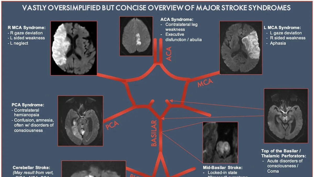 Stroke Mimics: A Higher Risk of Post-Traumatic Stress Disorder