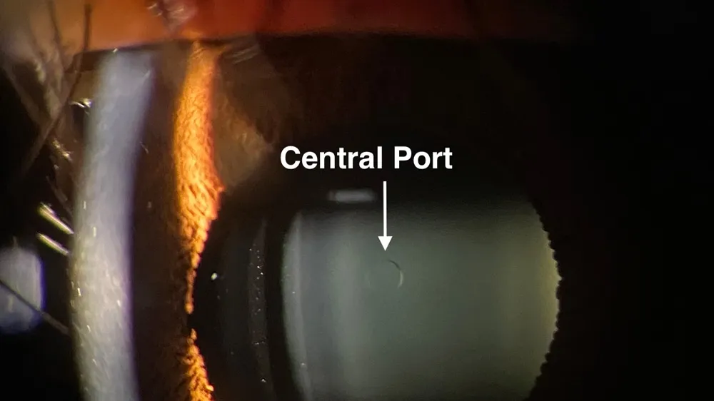 Understanding the Importance of Postoperative Vault in Implantable Collamer Lens Size Selection