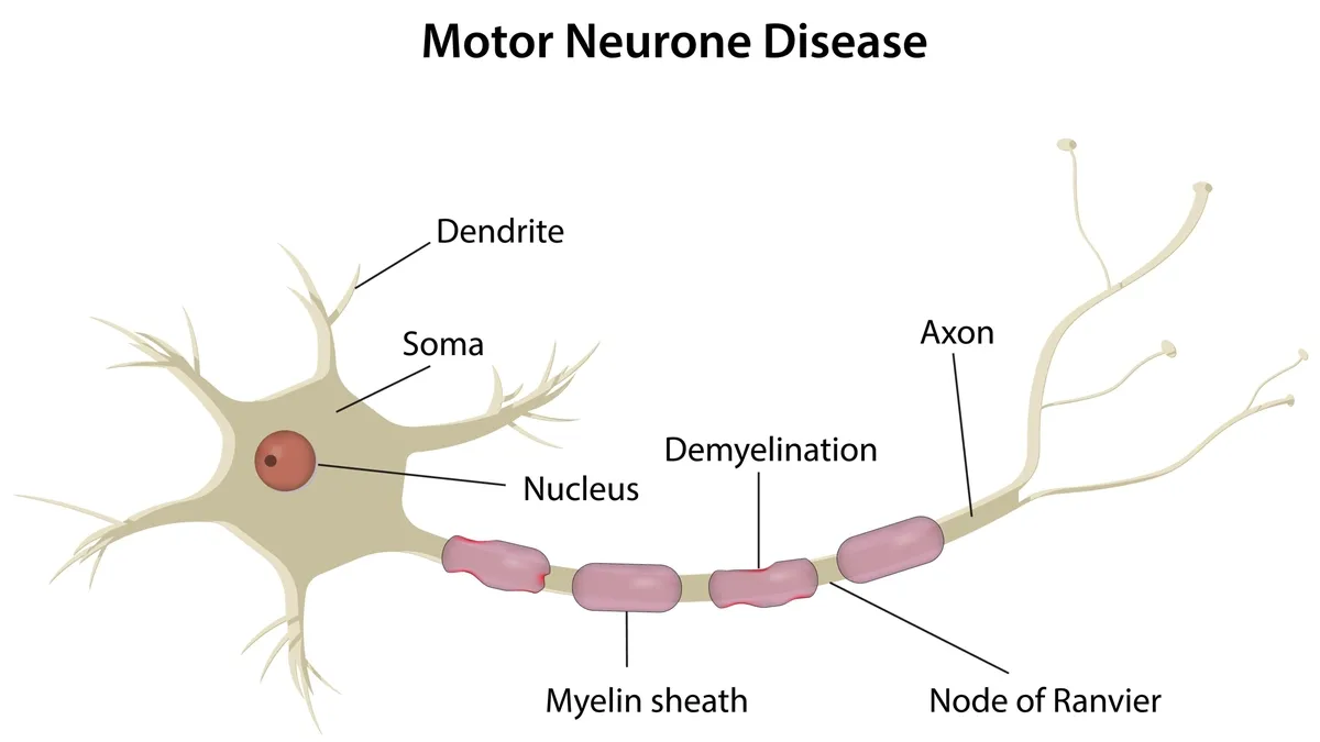 Unlocking the Secrets of Motor Neuron Disease: New Pathways and Potential Therapies