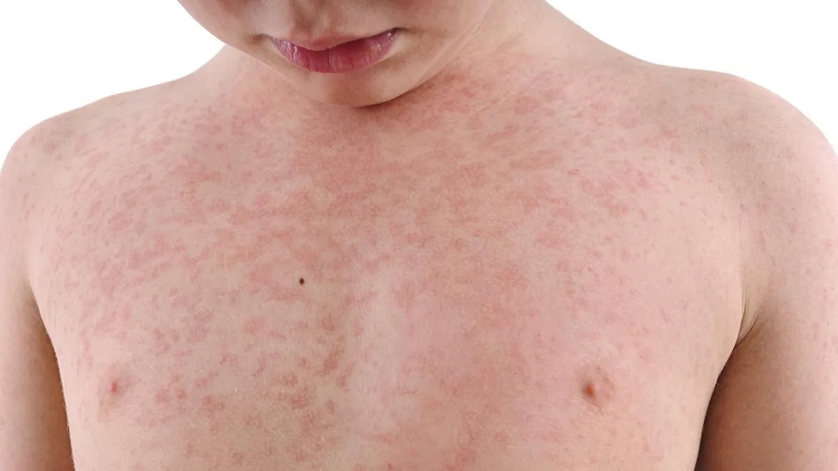 Measles Outbreak in Florida School: A Wake-Up Call on the Importance of Vaccination
