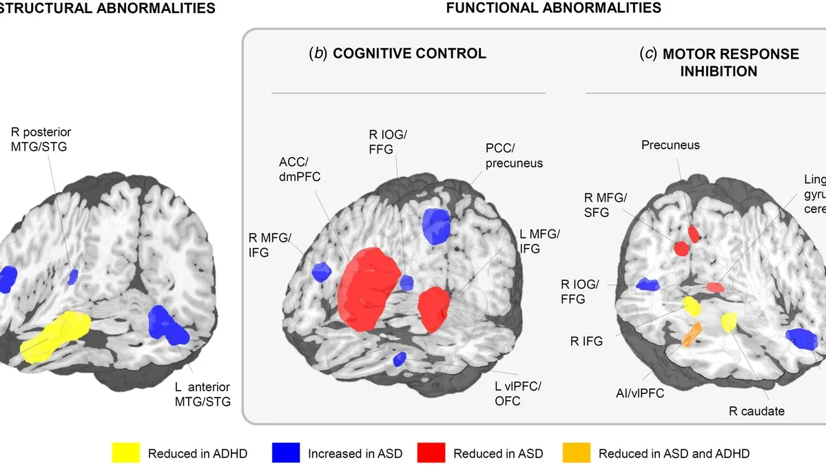 Exploring the Neural Links between ADHD and ASD: Insights and Future Directions