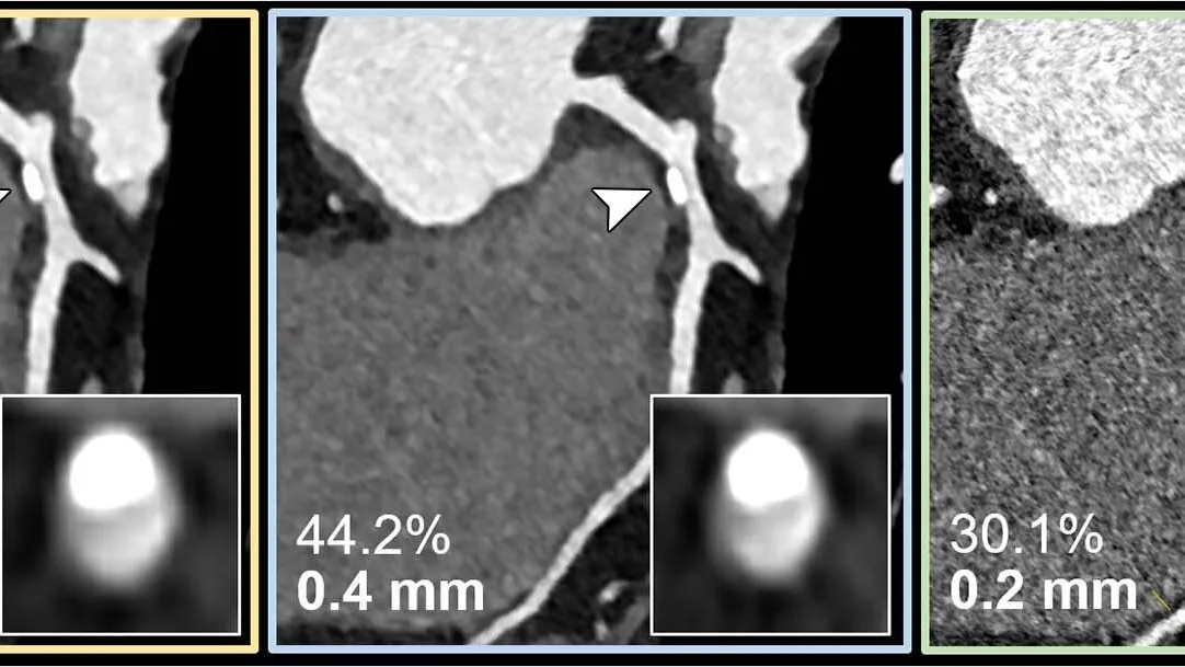 Ultrahigh-Spatial-Resolution PCD-CT: A Game Changer in Assessing Coronary Artery Disease