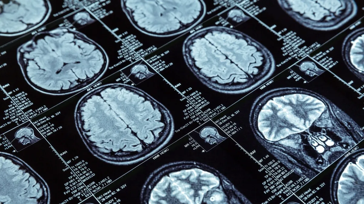 Predicting Psychosis Onset: How MRI Scans and Machine Learning Can Aid in Early Diagnosis