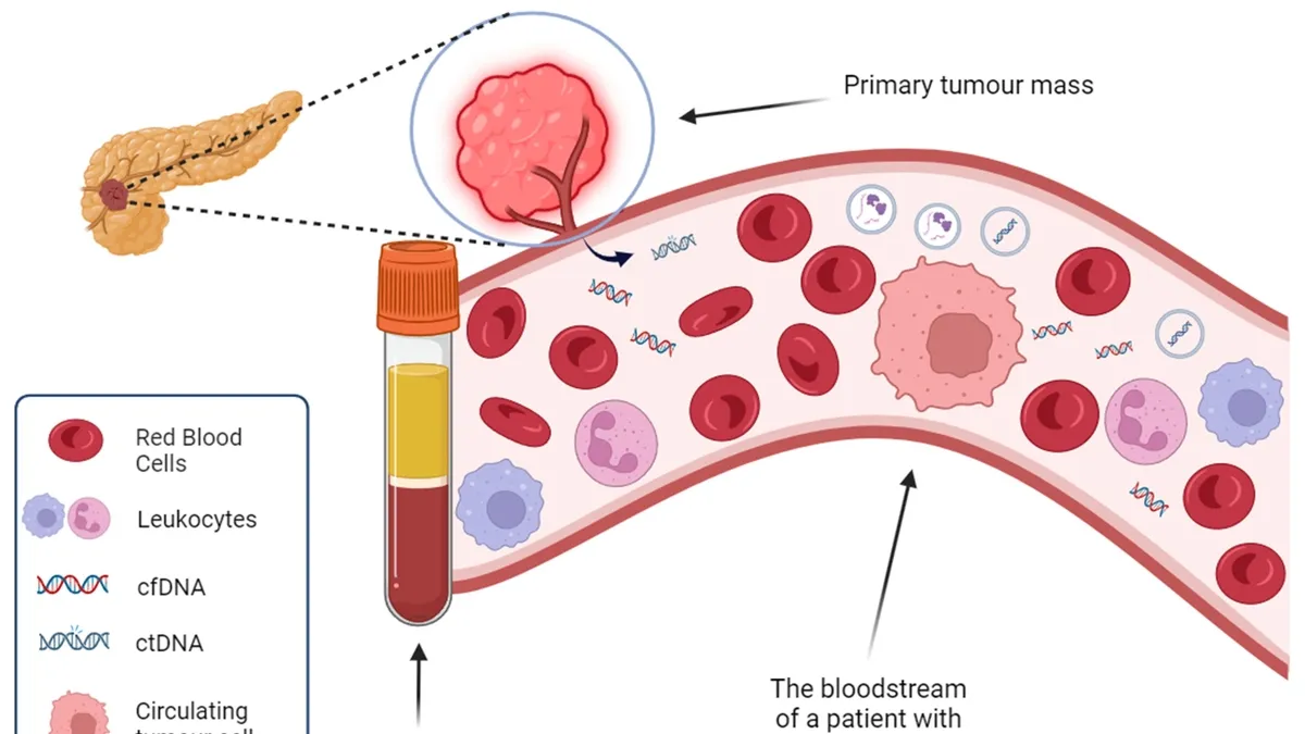 The Promise of Liquid Biopsy for Early-stage PDAC: A New Hope for Improved Patient Outcomes